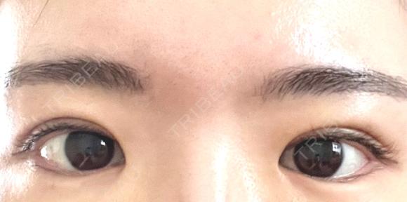 二重埋没 OMI CLINIC 【オミクリニック】 DAY 3 メイン用