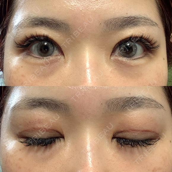 二重切開 LUHO（ルホ）美容外科 DAY 30 メイン用