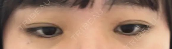 ヒアルロン酸注入（涙袋） AZ BEAUTY CLINIC AFTER メイン用