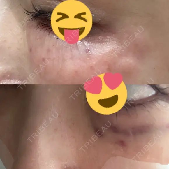 肌育注射（ジュベルックなど） BAO CLINIC 梅田院 AFTER メイン用