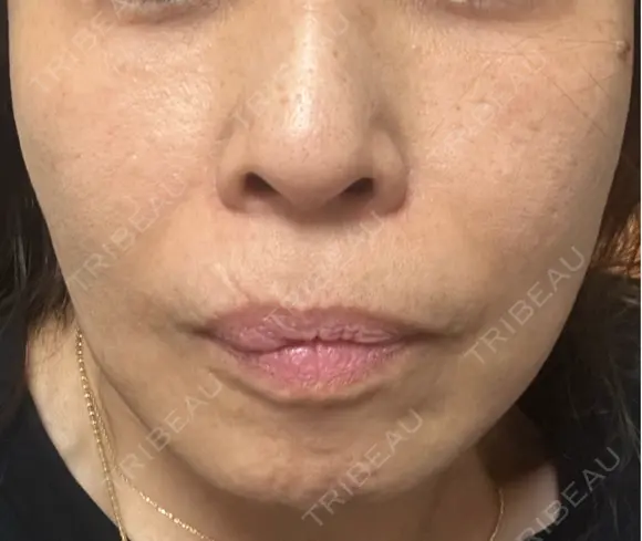 ショッピングリフト Natural Skin Clinic 笹塚院 DAY 28 メイン用