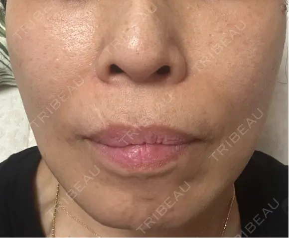 ショッピングリフト Natural Skin Clinic 笹塚院 DAY 25 メイン用