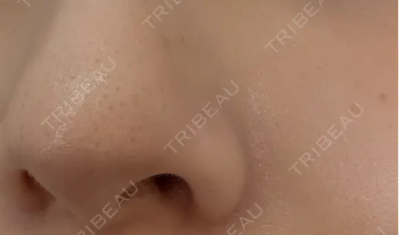 毛穴洗浄（ハイドラフェイシャルなど） クララビューティクリニック 札幌院 DAY 6 メイン用