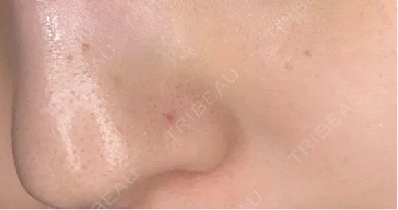 毛穴洗浄（ハイドラフェイシャルなど） クララビューティクリニック 札幌院 DAY 9 メイン用