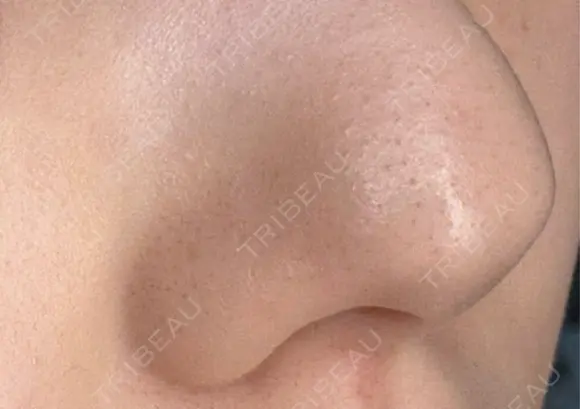 毛穴洗浄（ハイドラフェイシャルなど） クララビューティクリニック 札幌院 DAY 11 メイン用