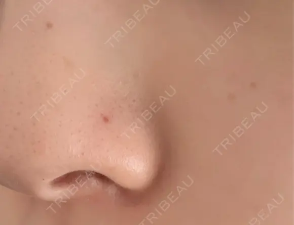 毛穴洗浄（ハイドラフェイシャルなど） クララビューティクリニック 札幌院 DAY 13 メイン用