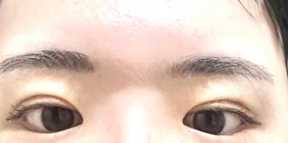 二重埋没 OMI CLINIC 【オミクリニック】 DAY 5 メイン用