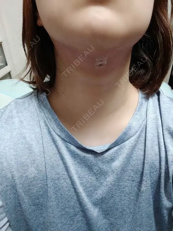 糸リフト / 脂肪吸引注射（顔） EMMO FACE CLINIC 大阪梅田院 DAY 1 メイン用