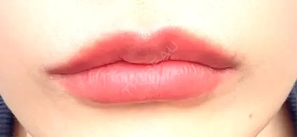 ヒアルロン酸注入（唇） Wi Clinic （ウィ クリニック）心斎橋院 DAY 4 メイン用