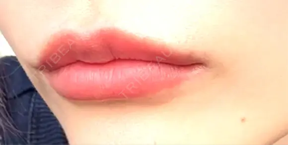 ヒアルロン酸注入（唇） Wi Clinic （ウィ クリニック）心斎橋院 DAY 4 メイン用