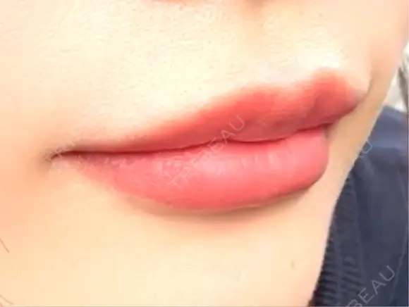 ヒアルロン酸注入（唇） Wi Clinic （ウィ クリニック）心斎橋院 DAY 4 メイン用