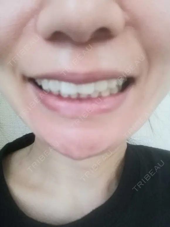 矯正（マウスピース） 銀座青山You矯正歯科 池袋西口医院 AFTER メイン用