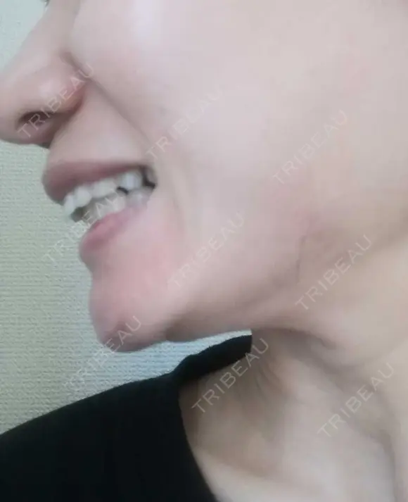 矯正（マウスピース） 銀座青山You矯正歯科 池袋西口医院 DAY 486 メイン用