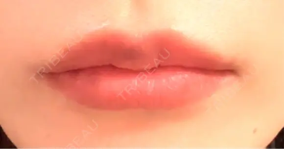 ヒアルロン酸注入（唇） Wi Clinic （ウィ クリニック）心斎橋院 DAY 3 メイン用