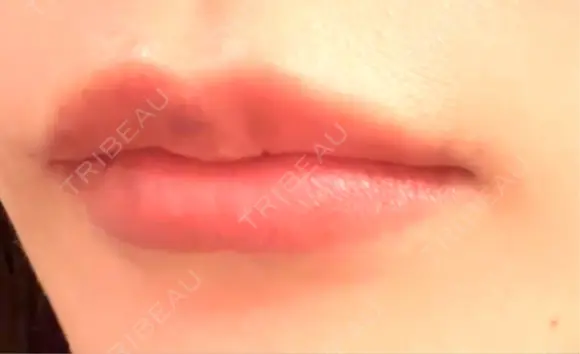 ヒアルロン酸注入（唇） Wi Clinic （ウィ クリニック）心斎橋院 DAY 3 メイン用