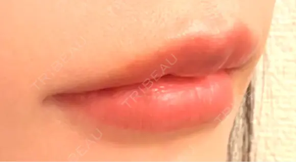 ヒアルロン酸注入（唇） Wi Clinic （ウィ クリニック）心斎橋院 DAY 3 メイン用