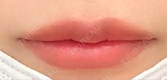 ヒアルロン酸注入（唇） Wi Clinic （ウィ クリニック）心斎橋院 AFTER メイン用