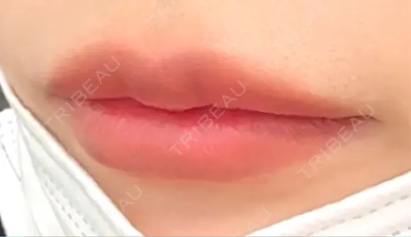 ヒアルロン酸注入（唇） Wi Clinic （ウィ クリニック）心斎橋院 DAY 6 メイン用