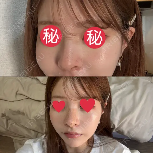 隆鼻術 / 鼻尖形成（切開） / 鼻中隔延長（切開） / 軟骨移植 THE ROPPONGI CLINIC（ザ 六本木クリニック） DAY 15 メイン用