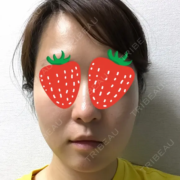 ボトックス（エラ・小顔） 湘南美容クリニック 京都院 DAY 0 メイン用