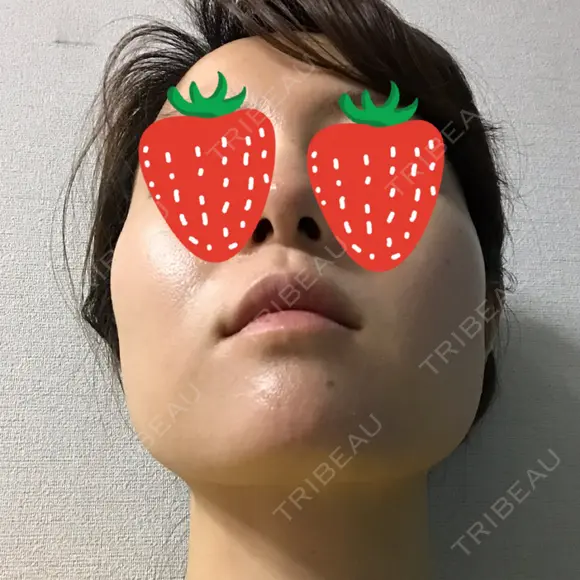 ボトックス（エラ・小顔） 湘南美容クリニック 京都院 DAY 0 メイン用