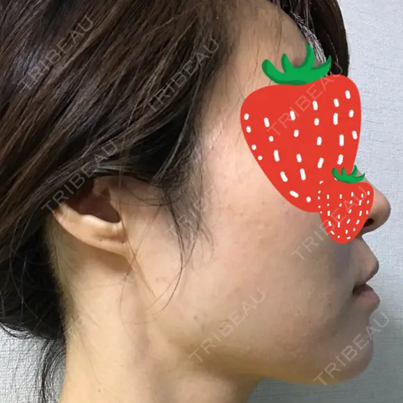 ボトックス（エラ・小顔） 湘南美容クリニック 京都院 DAY 0 メイン用