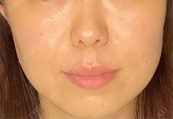 RF（高周波）たるみ治療 CZEN CLINIC 銀座院 DAY 0 メイン用