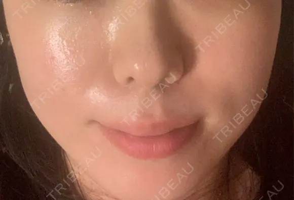 RF（高周波）たるみ治療 CZEN CLINIC 銀座院 DAY 30 メイン用