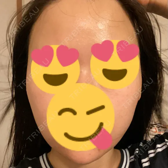 医療脱毛（顔） / ルメッカ 栄美容クリニック 栄院 DAY 0 メイン用