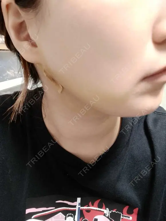 糸リフト / 脂肪吸引注射（顔） EMMO FACE CLINIC 大阪梅田院 DAY 3 メイン用