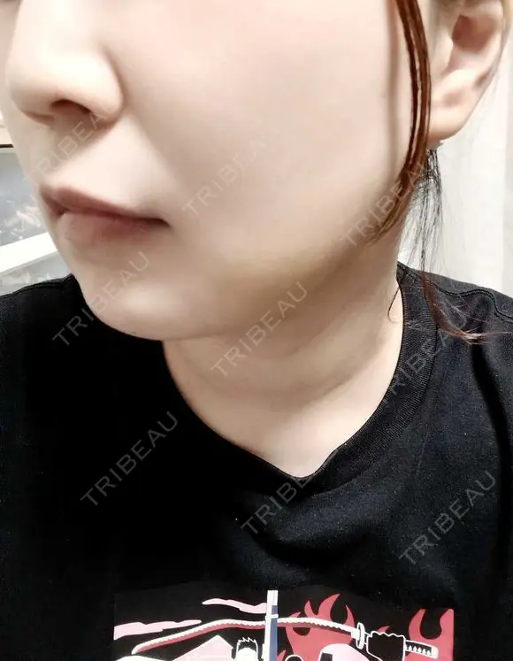 糸リフト / 脂肪吸引注射（顔） EMMO FACE CLINIC 大阪梅田院 DAY 3 メイン用