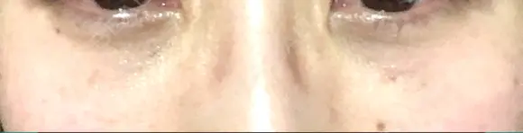 クマ治療 / 下まぶたたるみ取り 二子玉川美容外科クリニック DAY 12 メイン用