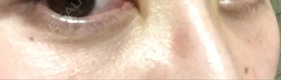 クマ治療 / 下まぶたたるみ取り 二子玉川美容外科クリニック DAY 12 メイン用