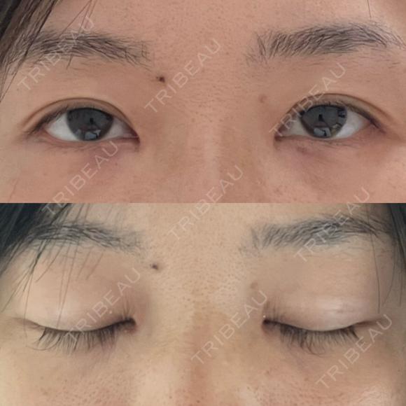 目頭切開 / 目尻切開 / 自然癒着法 LUHO（ルホ）美容外科 AFTER メイン用