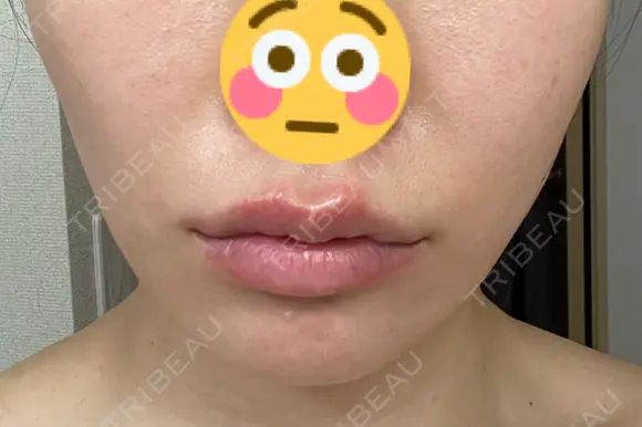 ヒアルロン酸注入（唇） ルラ美容クリニック 岐阜院 DAY 0 メイン用