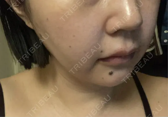 ヒアルロン酸注入（唇） / ヒアルロン酸注入（頬） Wi Clinic （ウィ クリニック）心斎橋院 DAY 0 メイン用