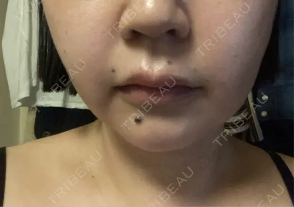 ヒアルロン酸注入（唇） / ヒアルロン酸注入（頬） Wi Clinic （ウィ クリニック）心斎橋院 DAY 0 メイン用