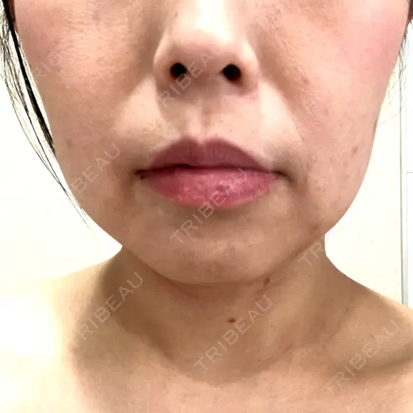 ボトックス（エラ・小顔） 日本ウェルネス再生クリニック DAY 0 メイン用