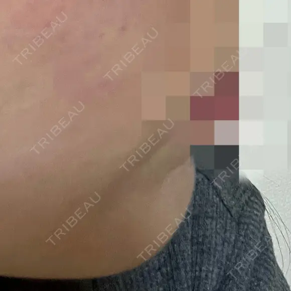 ボトックス（あご） 美容皮膚科エルムクリニック 岡山院 AFTER メイン用