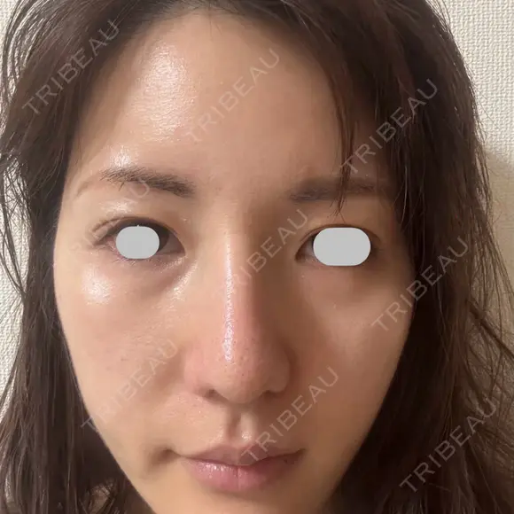 鼻尖形成（切開） / 小鼻縮小（切開） / その他（鼻） / 軟骨移植 eクリニック 福岡院 DAY 60 メイン用