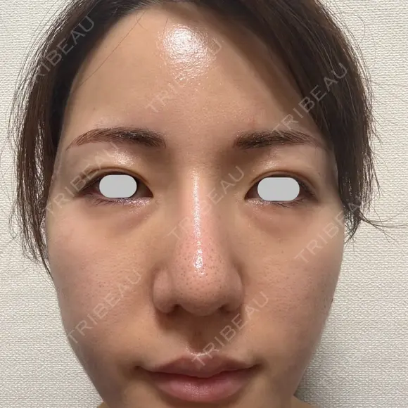 鼻尖形成（切開） / 小鼻縮小（切開） / その他（鼻） / 軟骨移植 eクリニック 福岡院 DAY 90 メイン用