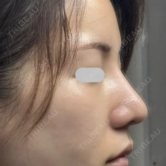 鼻尖形成（切開） / 小鼻縮小（切開） / その他（鼻） / 軟骨移植 eクリニック 福岡院 DAY 90 メイン用