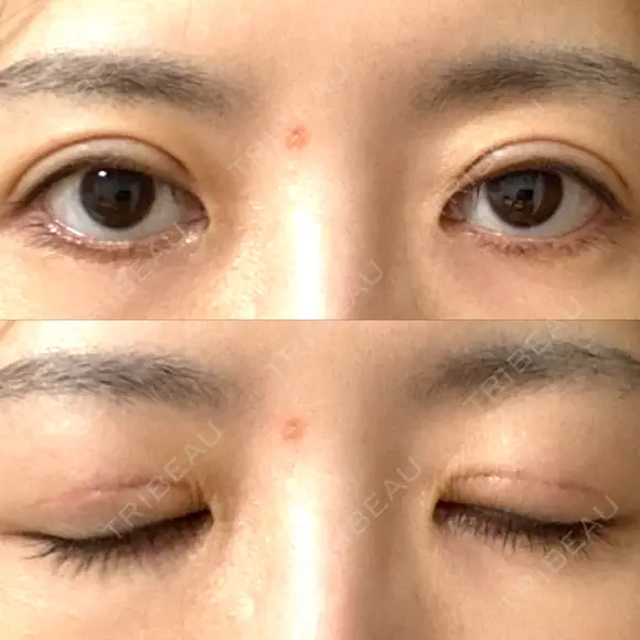 眼瞼下垂（切開） WOM CLINIC GINZA （ワム クリニック ギンザ） DAY 22 メイン用