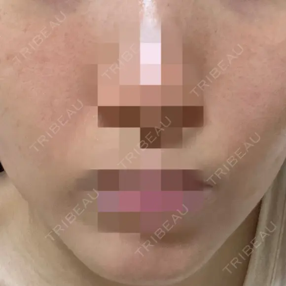 ポテンツァ ルラ美容クリニック 岡山院 DAY 1 メイン用