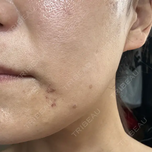 医療脱毛（ワキ） / ルメッカ ルラ美容クリニック 広島院 AFTER メイン用