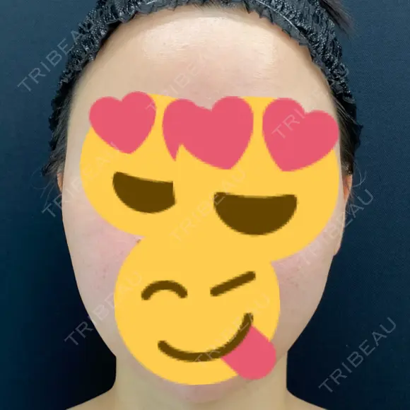 医療脱毛（顔） / ルメッカ 栄美容クリニック 栄院 DAY 1 メイン用