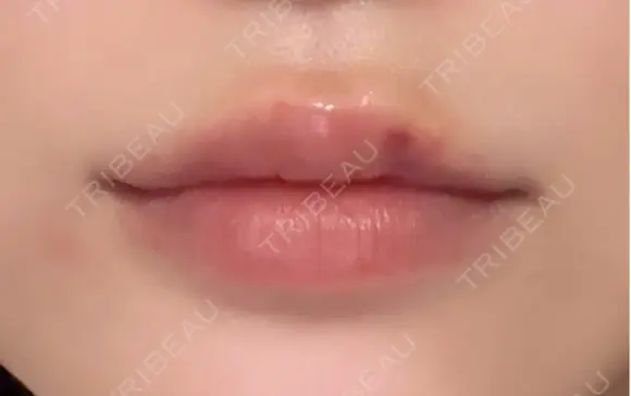 ヒアルロン酸注入（唇） Wing clinic 豊中駅前院 DAY 5 メイン用