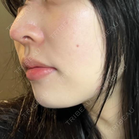 鼻尖形成（切開） / 鼻中隔延長（切開） / 軟骨移植 / 鼻孔縁下降 LIVIN CLINIC DAY 20 メイン用