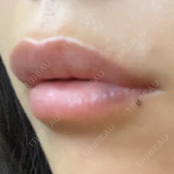 ヒアルロン酸注入（唇） アネシス美容クリニック DAY 2 メイン用