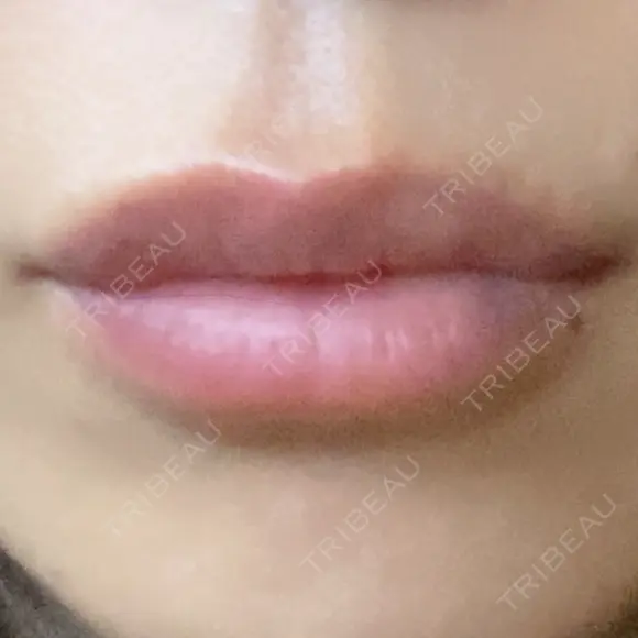 ヒアルロン酸注入（唇） アネシス美容クリニック DAY 3 メイン用